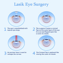 What does LASIK eye surgery feel like ? - Optilase